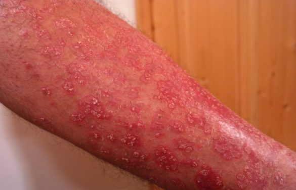 Psoriasis Causes Symptoms Treatments And Complications