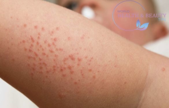 Skin Rash - Description of the elements of the Rash, Types and Treatment