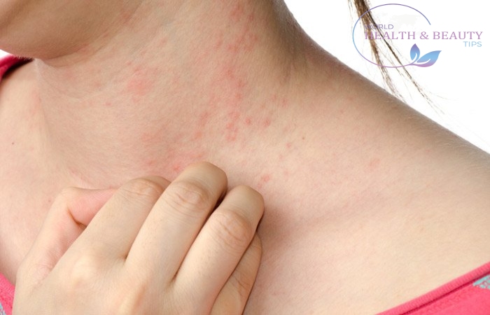 skin rash types