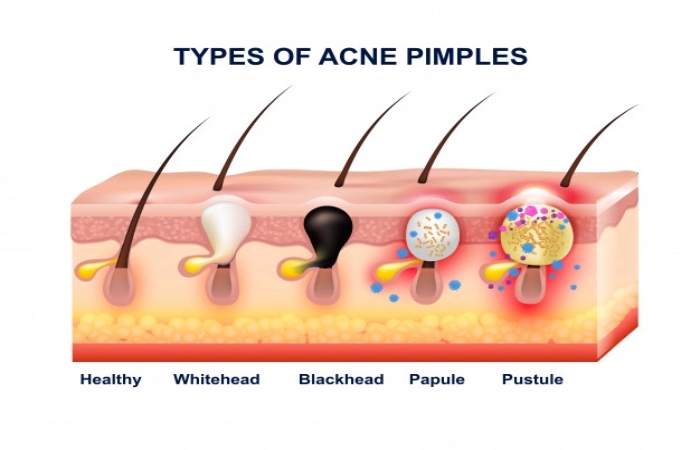  skin acne 