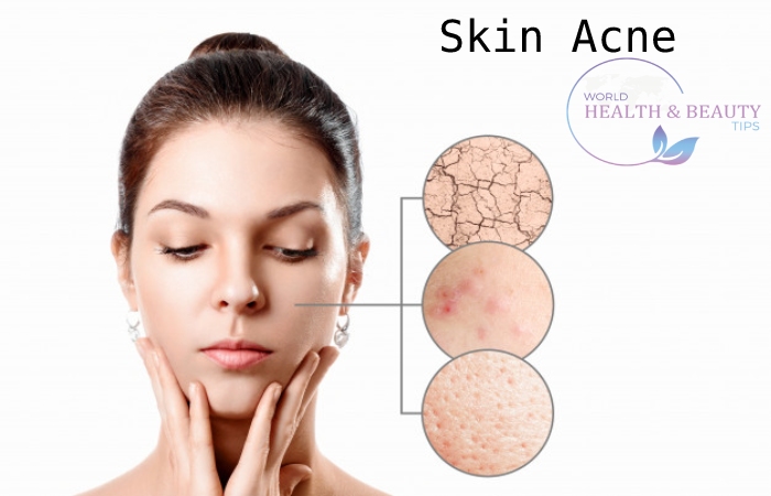 How to get rid of Acne 